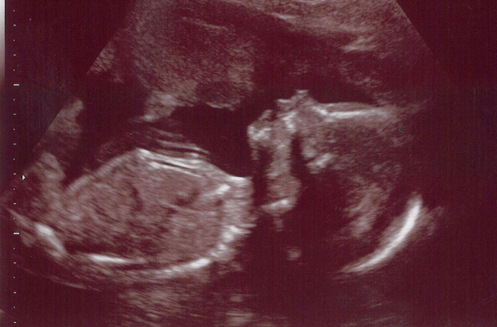 20-week-fetus.png