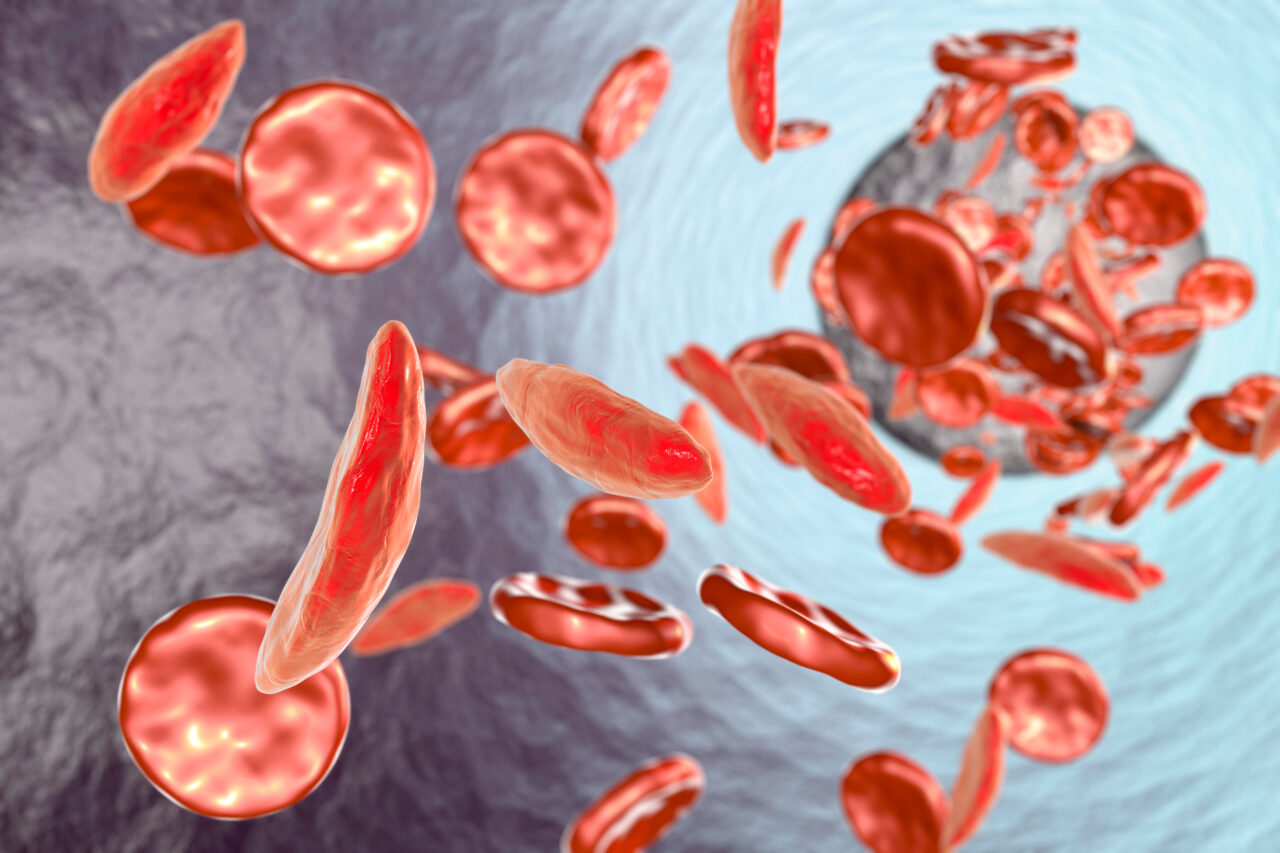 Sickle cell anemia, 3D illustration showing blood vessel with normal and deformated crescent-like red blood cells