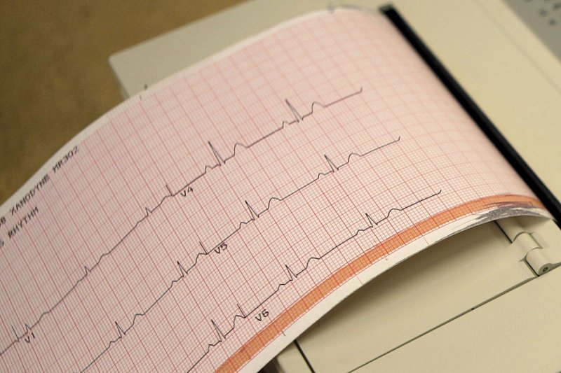 electrocardiogram-ap.jpeg