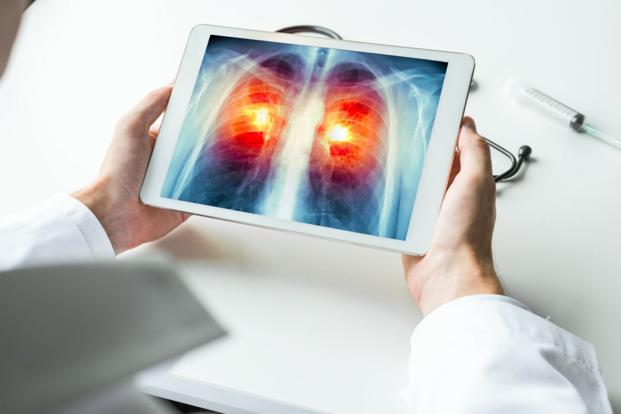 6383072 Doctor watching a xray of lung cancer on digital tablet.