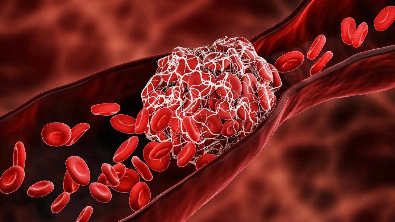 Blood Clot or thrombus blocking the red blood cells stream withi